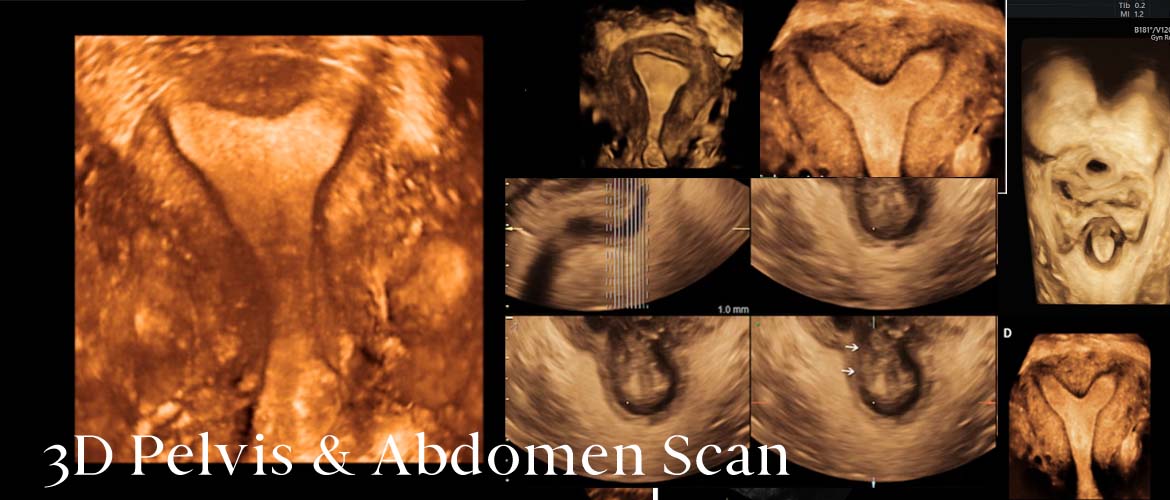 3D Pelvic Ultrasound Scan